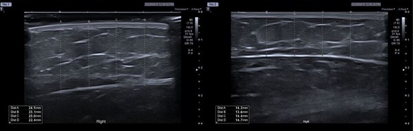 브이올렛 5㎖ 시술 전(사진 왼쪽)과 시술 후 팔뚝 피하지방을 촬영한 초음파 사진. 사진=대웅제약